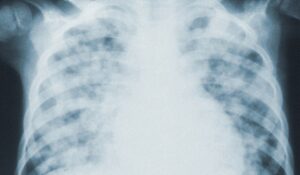 X-ray of ribcage