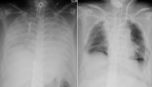 Lung transplant x-ray