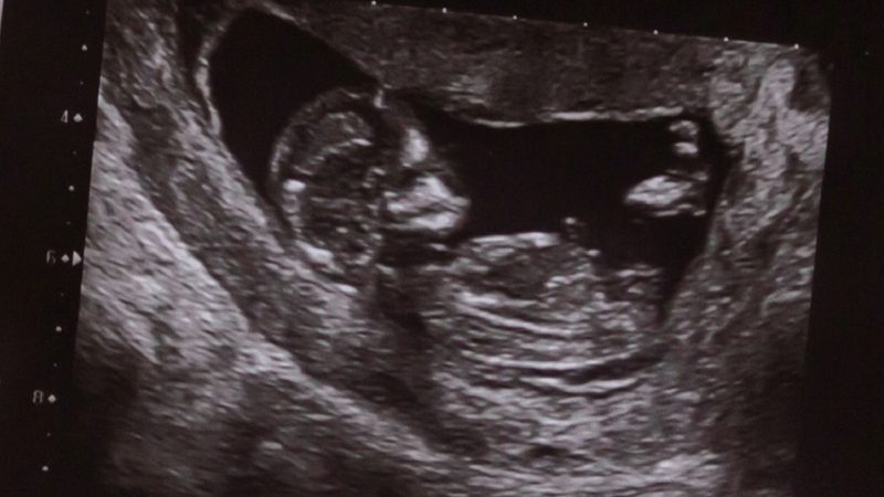 Ultrasound of human fetus